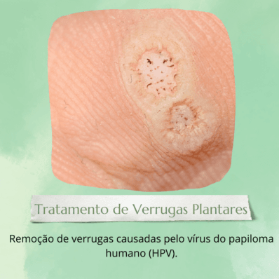 tratamnto de verrugas plantares